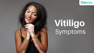 vitiligo symptoms