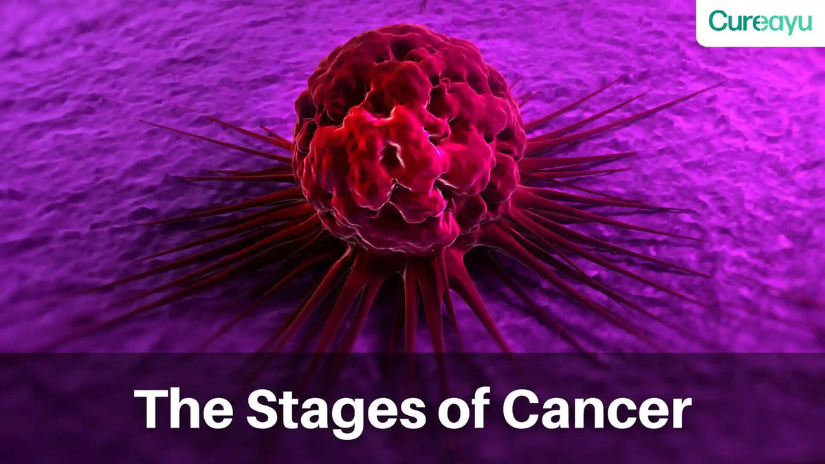 stages of cancer