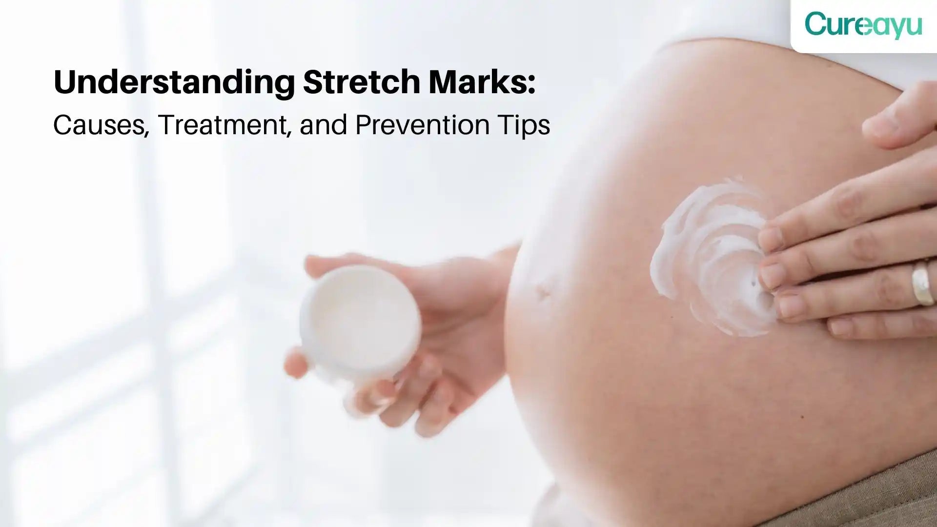 stretch marks