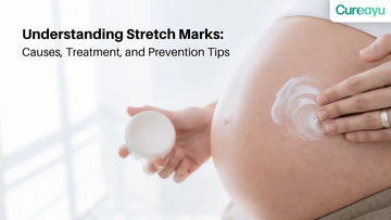 stretch marks