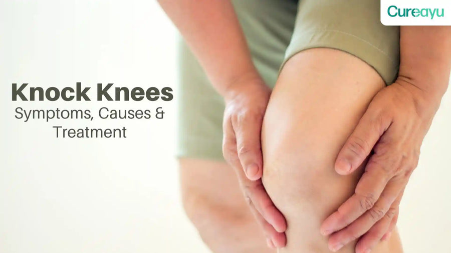 Understanding Knock Knees: Causes, Symptoms, Treatments, and When to Seek Medical Attention